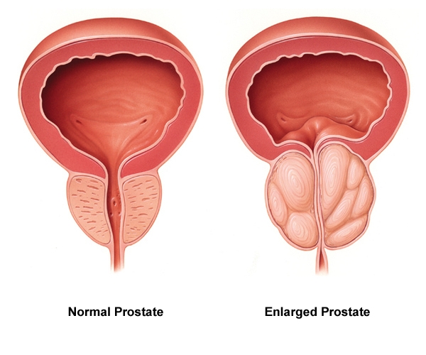 enlarged prostate vs normal prostate