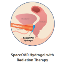 SpaceOAR with Radiation Therapy