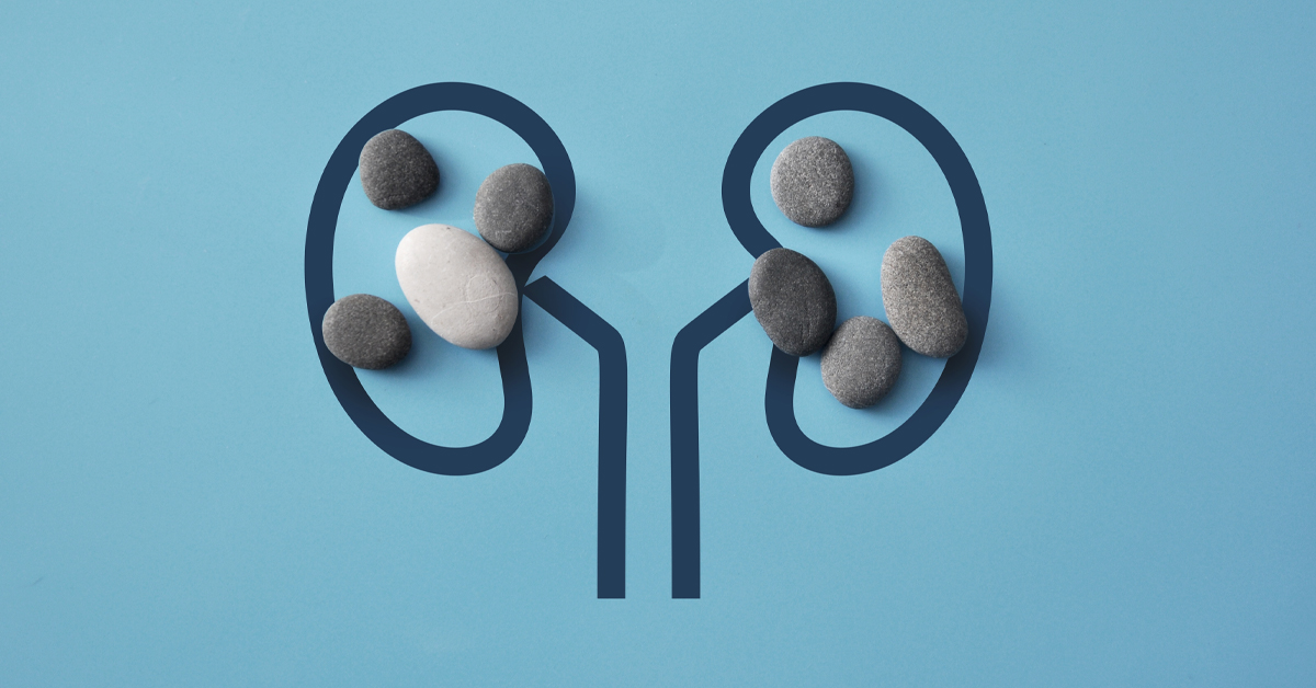 Kidney-stones-UCI